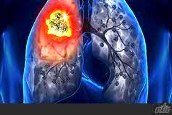 مشخصه مرحله حاد بیماری کرونا افزایش بارز مارکرهای سرمی التهابی است