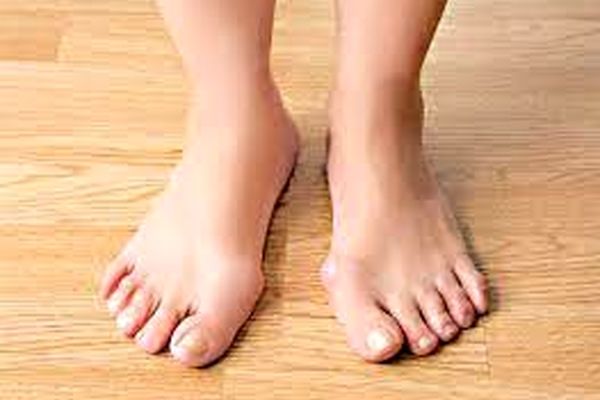 روش‌های طبیعی برای تسکین درد انحراف شست پا