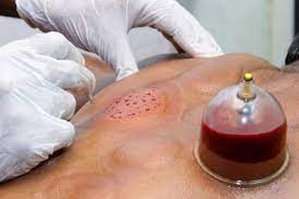 حجامت در پیشگیری از کرونا موثر است