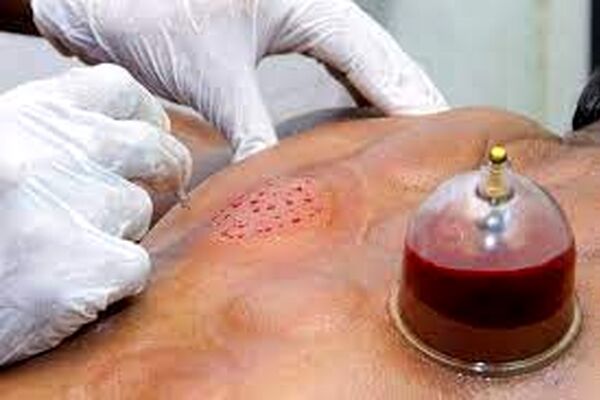حجامت در پیشگیری از کرونا موثر است