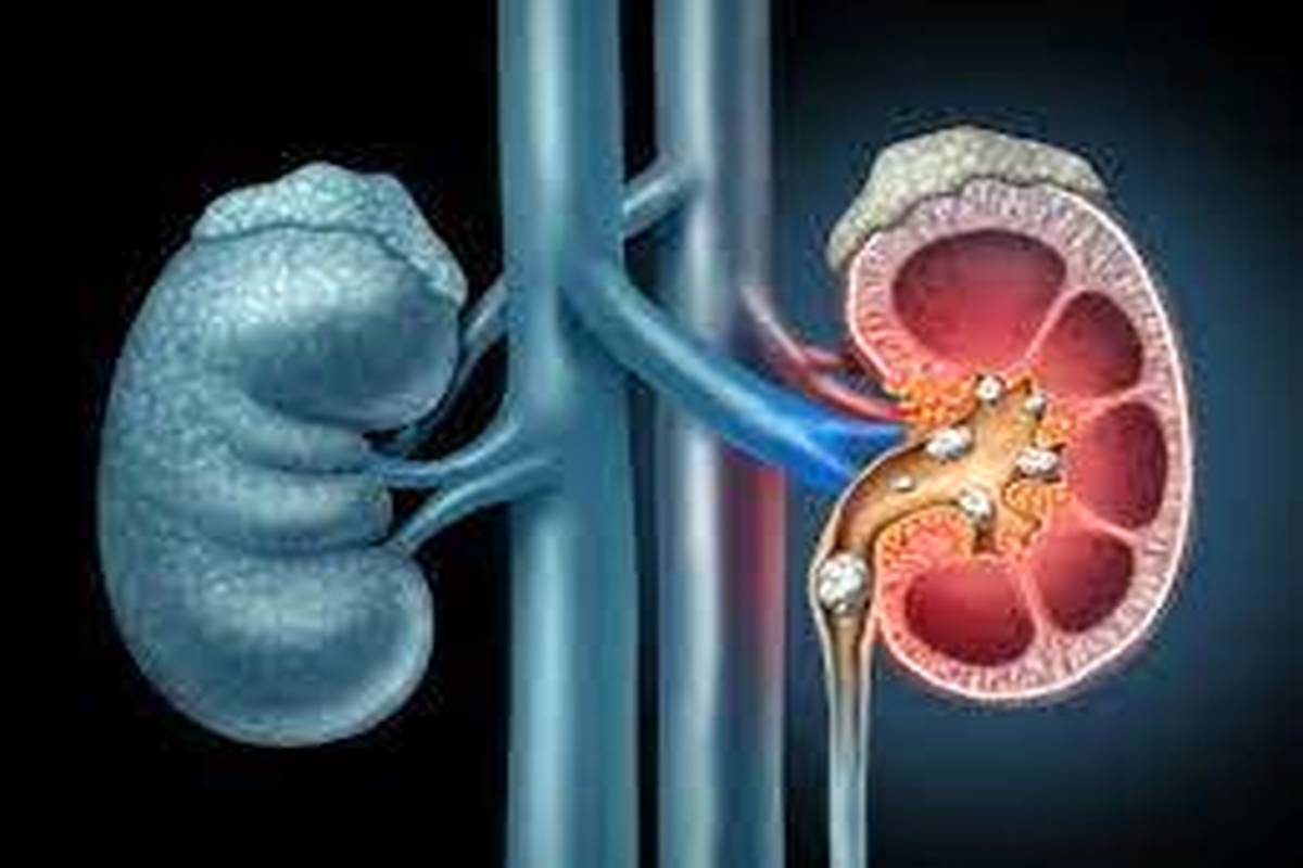چگونه از کلیه سنگساز مراقب کنیم؟