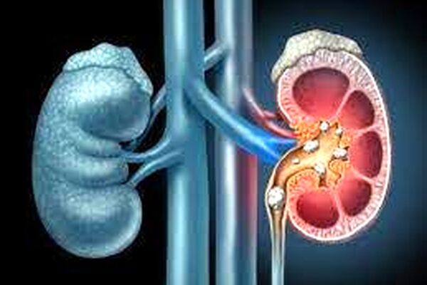 چگونه از کلیه سنگ‌ساز مراقب کنیم؟