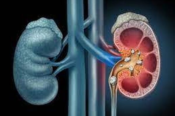 چگونه از کلیه سنگ‌ساز مراقب کنیم؟