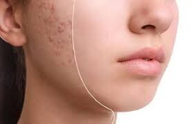 راه‌های درمان آکنه به صورت خوراکی و موضعی!