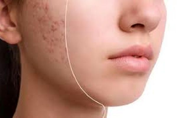 راه‌های درمان آکنه به صورت خوراکی و موضعی!