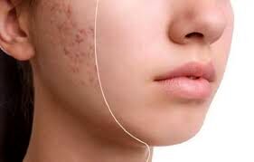 راه‌های درمان آکنه به صورت خوراکی و موضعی!