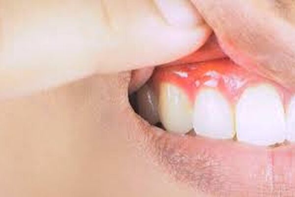 داروهای سوزش معده برای کاهش بیماری لثه مفید است