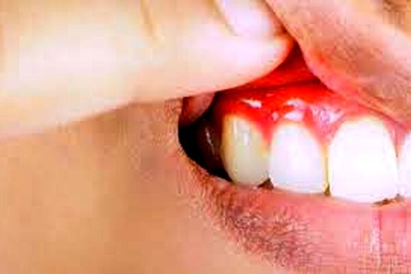 داروهای سوزش معده برای کاهش بیماری لثه مفید است