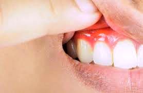 داروهای سوزش معده برای کاهش بیماری لثه مفید است