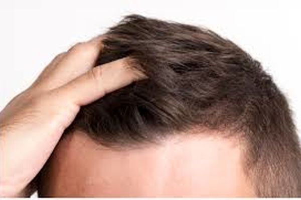 این چند خوراکی باعث ریزش مو می‌شود!