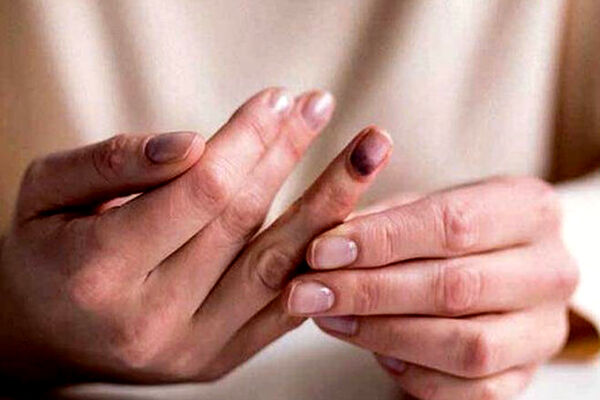 بی‌حسی و گزگز بدن برای چیست؟/ علت ۵ کمبود در بدن را بشناسید