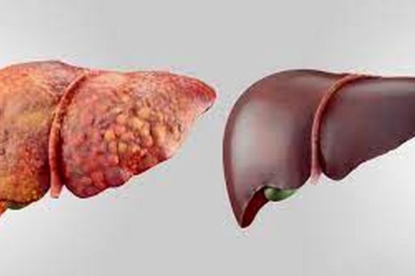 7 عاملی که باعث بروز بیماری کبد چرب می‌شود