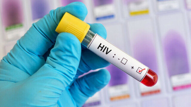 ۳۰میلیون نفر در دنیا مبتلا به ویروس HIV هستند