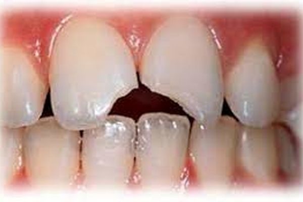 با این روش‌ها ترک خوردگی دندان را درمان کنید