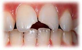 با این روش‌ها ترک خوردگی دندان را درمان کنید