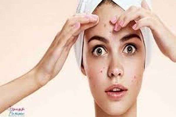 10 روش خانگی برای درمان جوش صورت