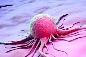 علل سرطان معده و علائم اصلی آن را بدانید