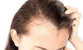 این ماده غذایی سالم با ریزش مو ارتباط عجیبی دارد
