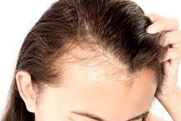 این ماده غذایی سالم با ریزش مو ارتباط عجیبی دارد
