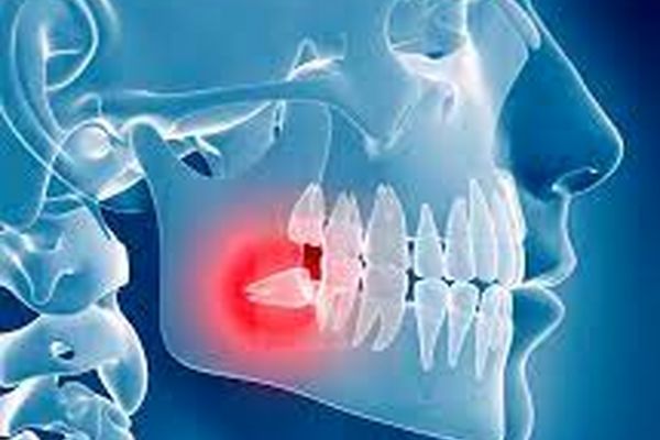 دلیل رشد با تاخیر و دیر هنگام دندان عقل را بدانید