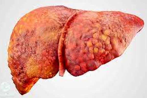 چند راهکار ساده در طب سنتی برای پیشگیری از ابتلا به کبد چرب 