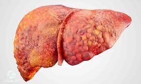 چند راهکار ساده در طب سنتی برای پیشگیری از ابتلا به کبد چرب 