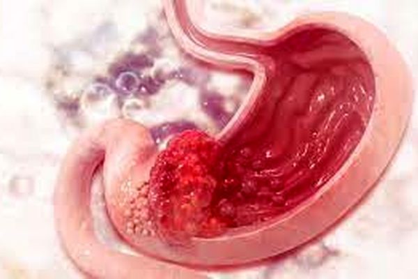 این گروه خونی بیشتر در معرض ابتلا به سرطان معده هستند