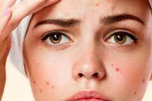 چه عواملی باعث تحریک و افزایش جوش صورت می‌شود