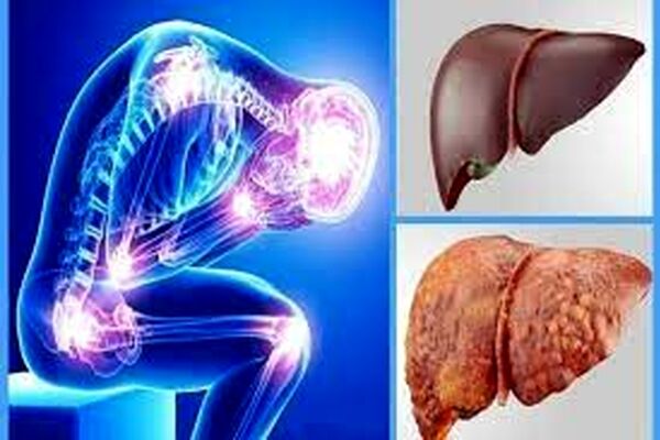۲۵ تا ۴۵ درصد از افراد مبتلا به بیماری کبد چرب هستند