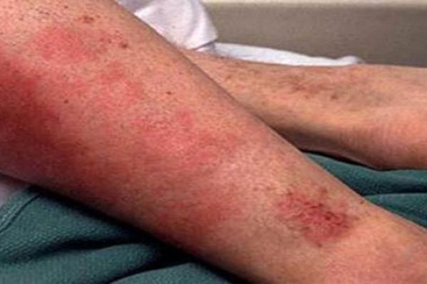 ابتلا به تب مالت در تربت جام ۵۰ درصد کاهش یافت