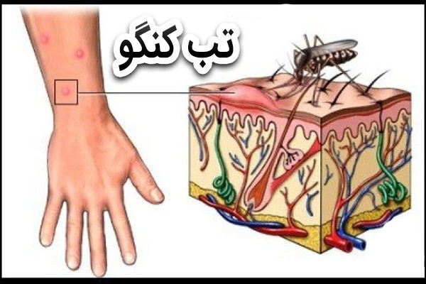 توصیه های بهداشتی جهت مراقبت از ابتلا به تب کریمه کنگو