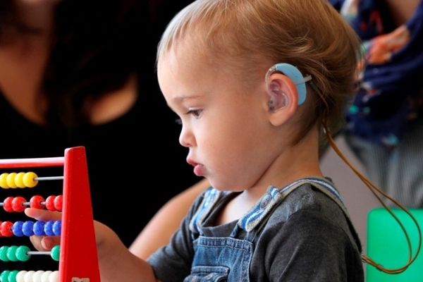 کودکان زیر ۴ سال در اولویت عمل کاشت حلزون