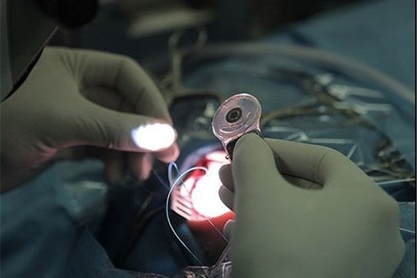 شناسایی ۳۰۰ کودک نیازمند کاشت حلزون در خراسان رضوی