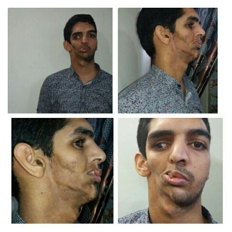 اشتباه پزشکی باز هم حادثه آفرید/صورت جوان مشهدی به دلیل خطای پزشکی آتروفی شد