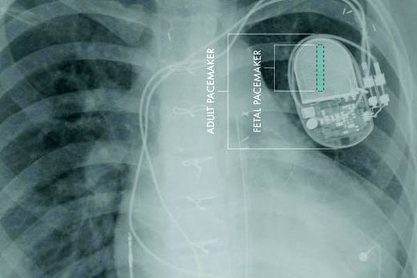 ساخت ضربان‌ساز مینیاتوری برای قلب جنین انسان