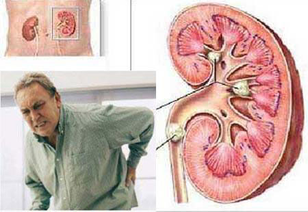 چرا اکثر ایرانیان سنگ کلیه می‌گیرند؟