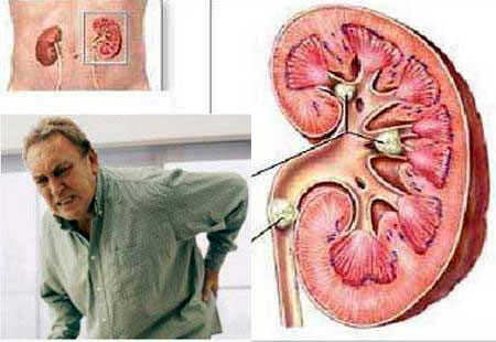 چرا اکثر ایرانیان سنگ کلیه می‌گیرند؟