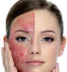 با استفاده از این 7 کلید طلایی با جوش و کک مک خداحافظی کنید