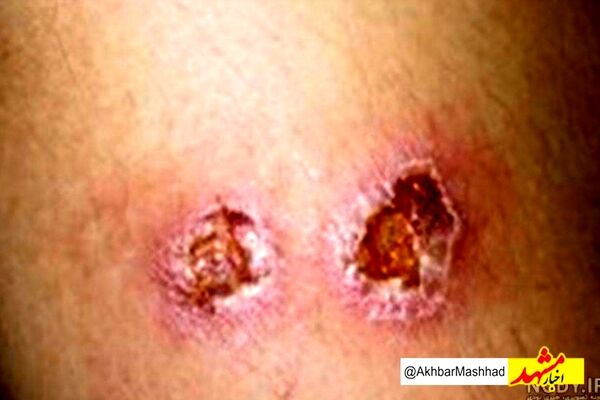 کاهش چشمگیر آمار سالک در خراسان رضوی؛ ۱۶۱ مبتلا در سال جاری/ پشه خاکی و نخاله‌های ساختمانی همچنان تهدید اصلی سالک در مشهد