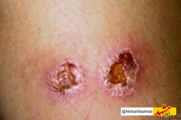 کاهش چشمگیر آمار سالک در خراسان رضوی؛ ۱۶۱ مبتلا در سال جاری/ پشه خاکی و نخاله‌های ساختمانی همچنان تهدید اصلی سالک در مشهد
