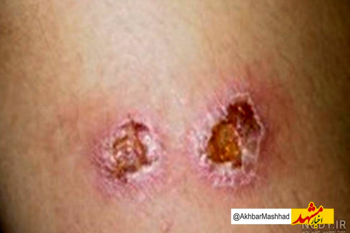 کاهش چشمگیر آمار سالک در خراسان رضوی؛ ۱۶۱ مبتلا در سال جاری/ پشه خاکی و نخالههای ساختمانی همچنان تهدید اصلی سالک در مشهد