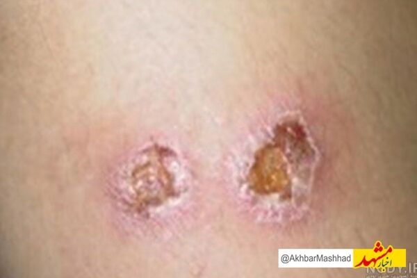 کاهش چشمگیر آمار سالک در خراسان رضوی؛ ۱۶۱ مبتلا در سال جاری/ پشه خاکی و نخاله‌های ساختمانی همچنان تهدید اصلی سالک در مشهد