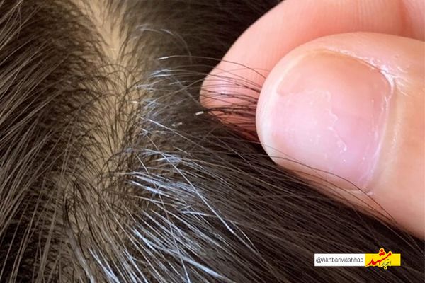  ابتلای بیش از ۸ هزار نفر به شپش در خراسان رضوی / بیشترین موارد در میان کودکان ۶ تا ۱۰ سال