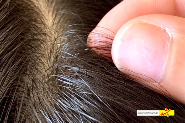  ابتلای بیش از ۸ هزار نفر به شپش در خراسان رضوی / بیشترین موارد در میان کودکان ۶ تا ۱۰ سال