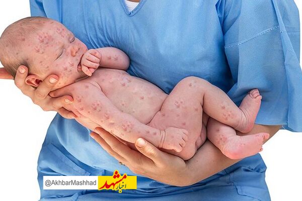 احتمال نقص نوزادان متولد شده از مادران مبتلا به سرخجه