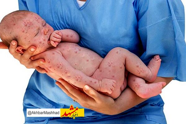 احتمال نقص نوزادان متولد شده از مادران مبتلا به سرخجه