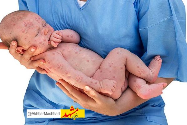 احتمال نقص نوزادان متولد شده از مادران مبتلا به سرخجه