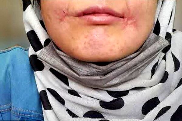 مرد معتاد لب‌های زن ۱۸ ساله‌اش را دوخت| اظهارات تکان‌دهنده فائزه در کلانتری خواجه‌ربیع مشهد