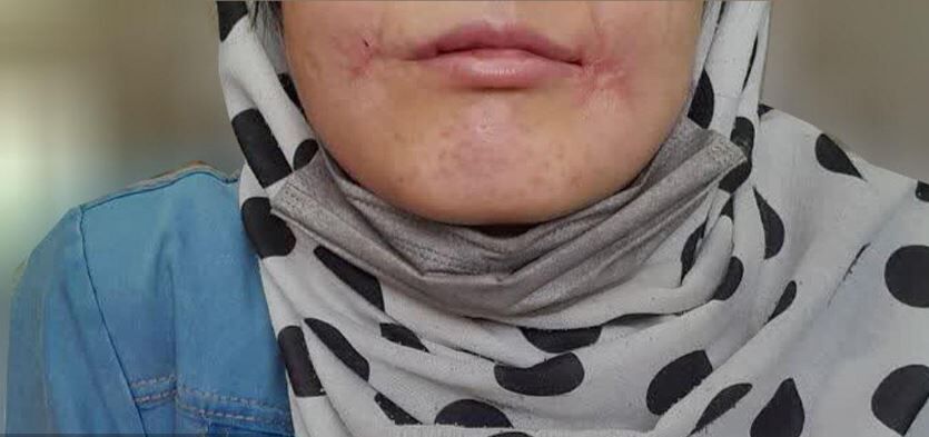 مرد معتاد لب‌های زن ۱۸ ساله‌اش را دوخت| اظهارات تکان‌دهنده فائزه در کلانتری خواجه‌ربیع مشهد