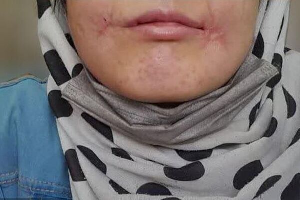 مرد معتاد لب‌های زن ۱۸ ساله‌اش را دوخت| اظهارات تکان‌دهنده فائزه در کلانتری خواجه‌ربیع مشهد